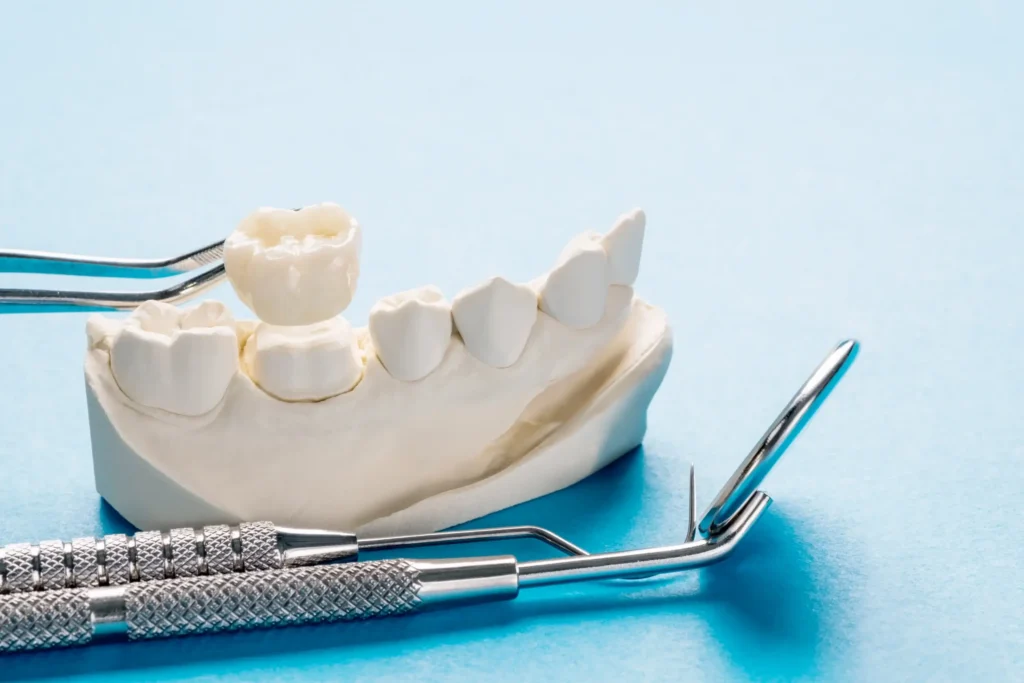 Tooth-colored ceramic dental crown treatment by Dr. Pawar in Thane West, Maharashtra