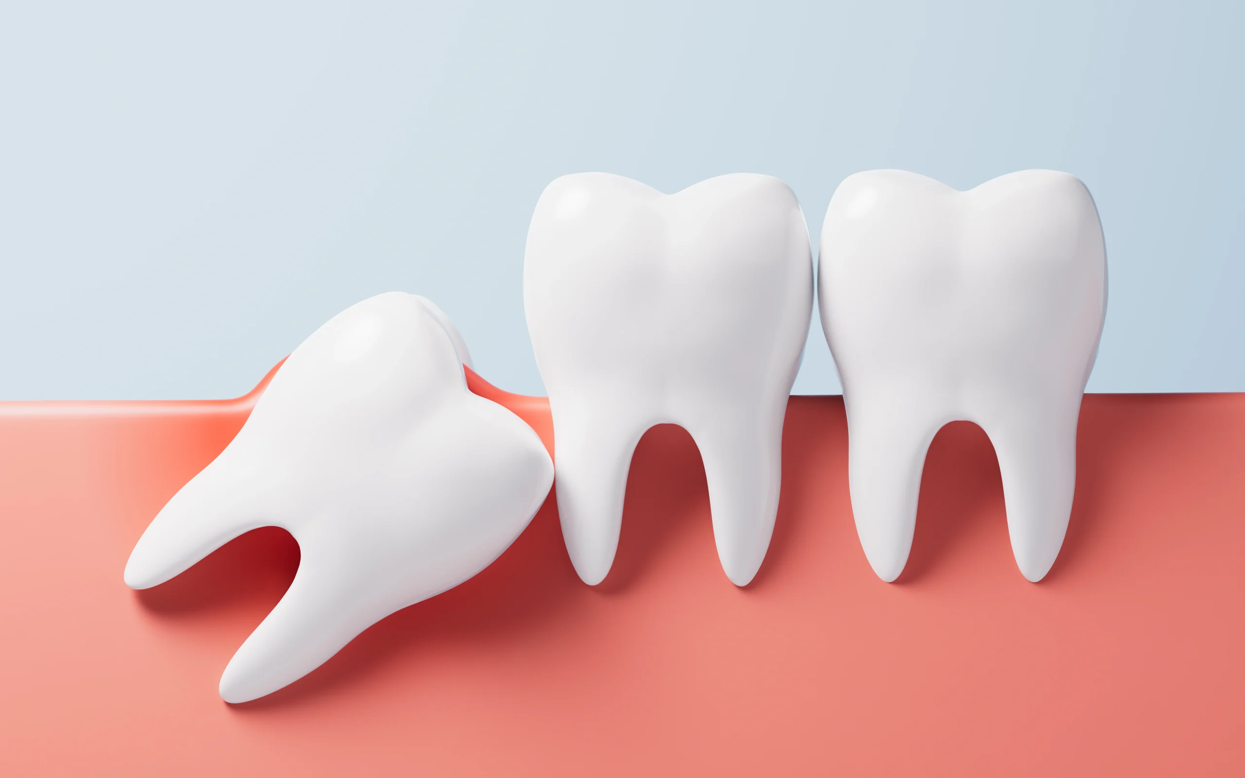 Mesial wisdom tooth impaction illustration - Dr. Pawar's Advanced Dentistry Thane West