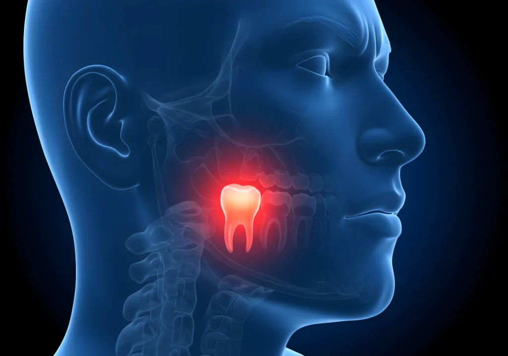 Anatomical illustration of wisdom tooth location in the jaw - Dr. Pawar's Advanced Dentistry Thane West