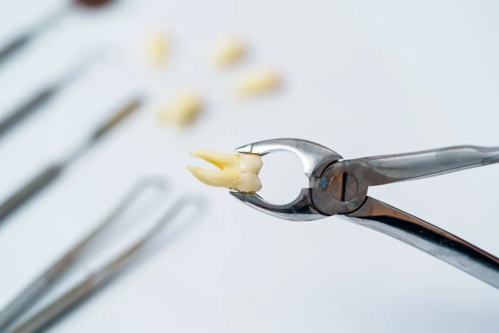 Why choose wisdom teeth removal benefits illustration - Dr. Pawar's Advanced Dentistry Thane West