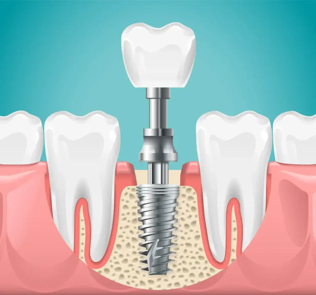 Dental implants treatment for missing teeth