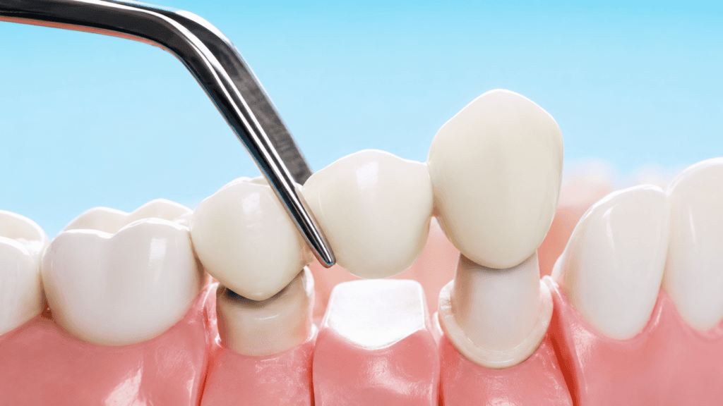 Ceramic dental crown restoration fitted on a patient's tooth at Dr. Pawar's Advanced Dentistry in Thane.