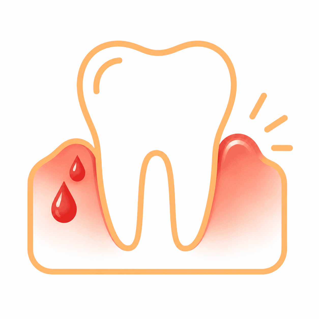Illustration of red, swollen, and bleeding gums showing signs of gum disease - Dr. Pawar's Advanced Dentistry Thane West
