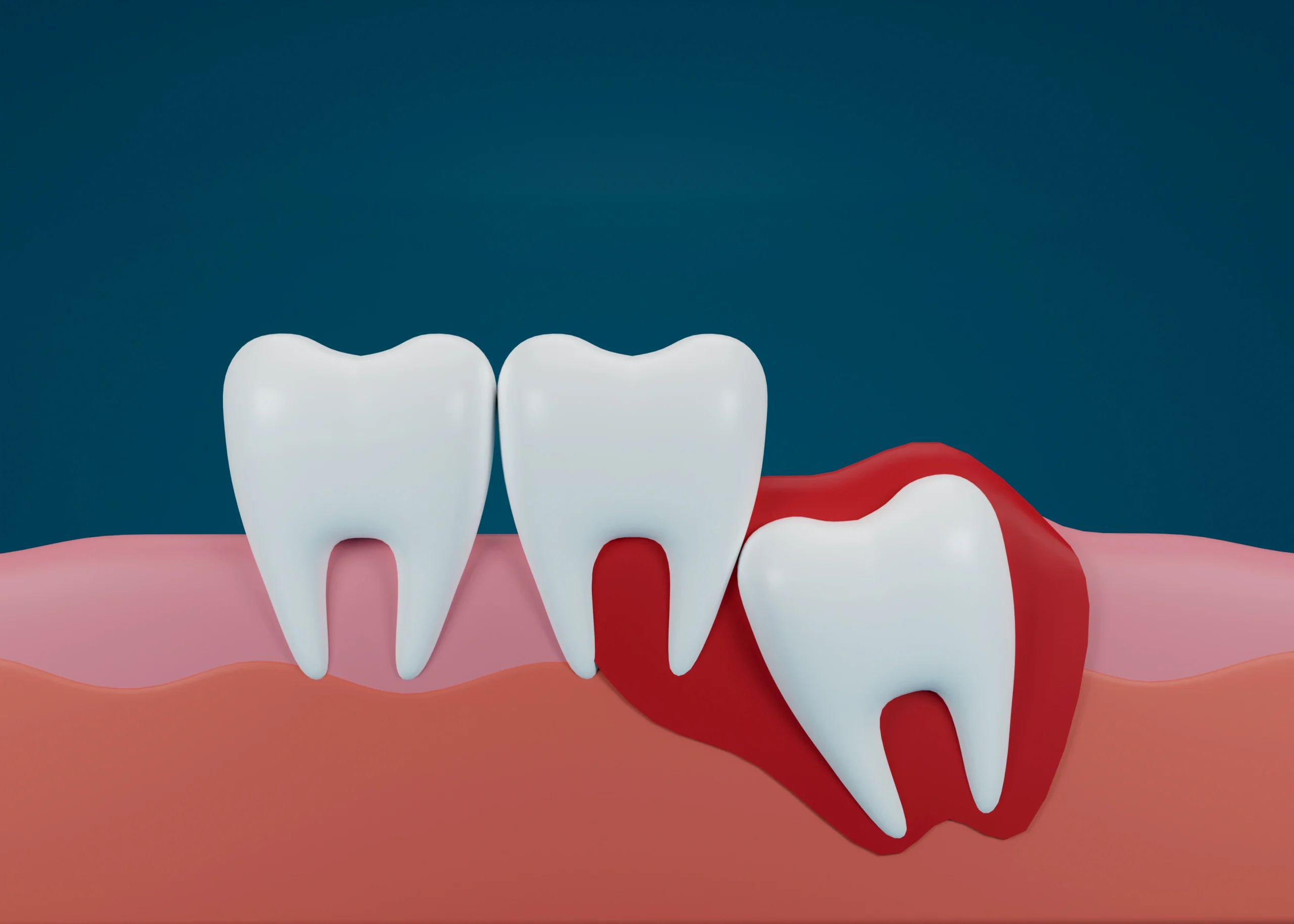 complete impaction
