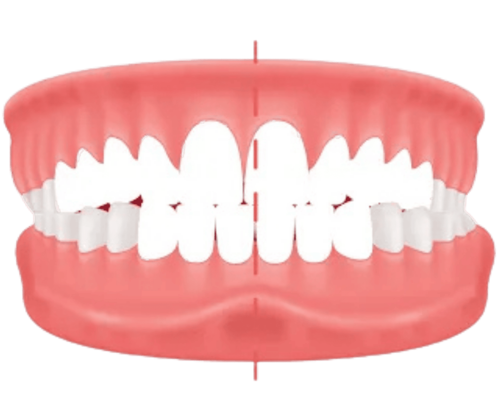 Illustration showing a crossbite where upper teeth sit inside the lower teeth, treatable with invisible aligners at Dr. Pawar's Advanced Dentistry in Thane West.