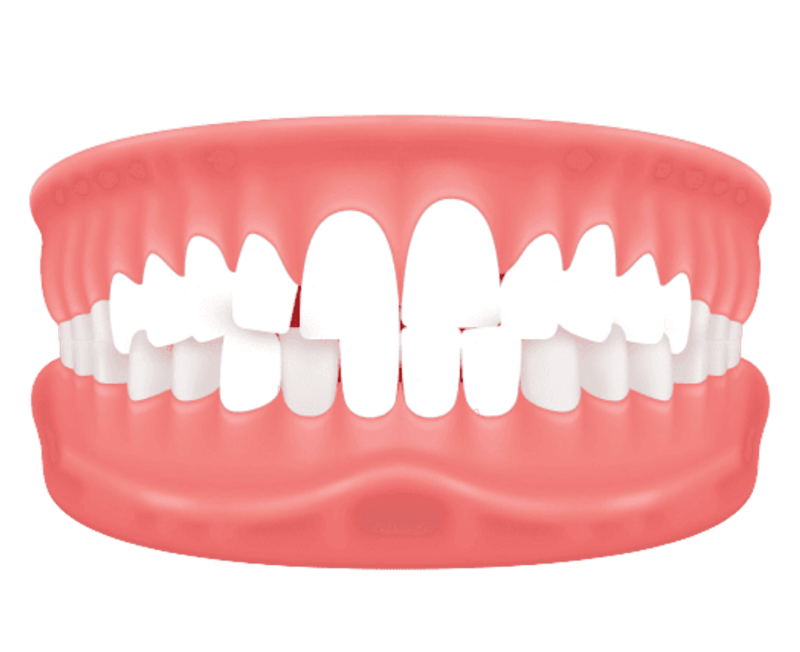 Dental crowding showing overlapping and cramped teeth, commonly treated with invisible aligners at Dr. Pawar's Advanced Dentistry in Thane West.