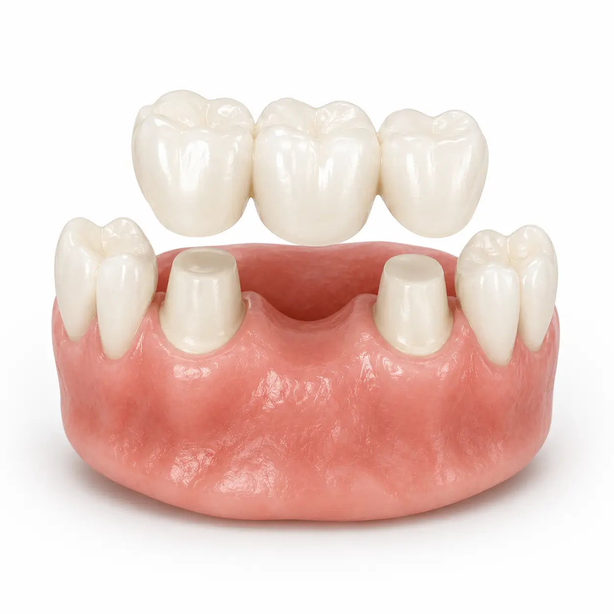 Custom dental crowns and bridges restoration for international patients in Thane, India