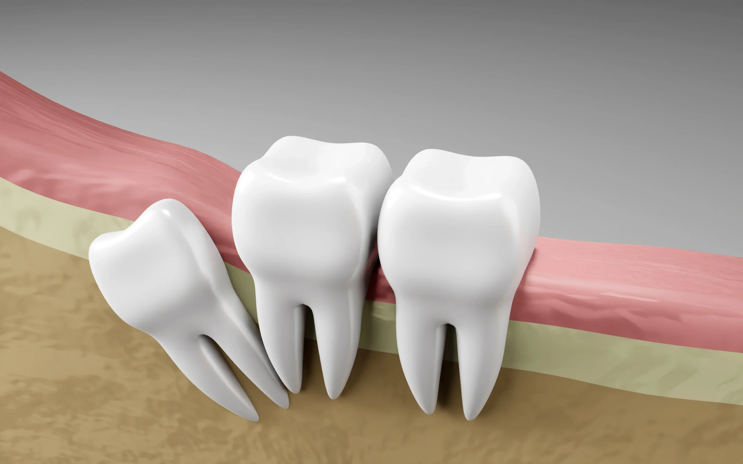 Distal wisdom tooth impaction illustration - Dr. Pawar's Advanced Dentistry Thane West