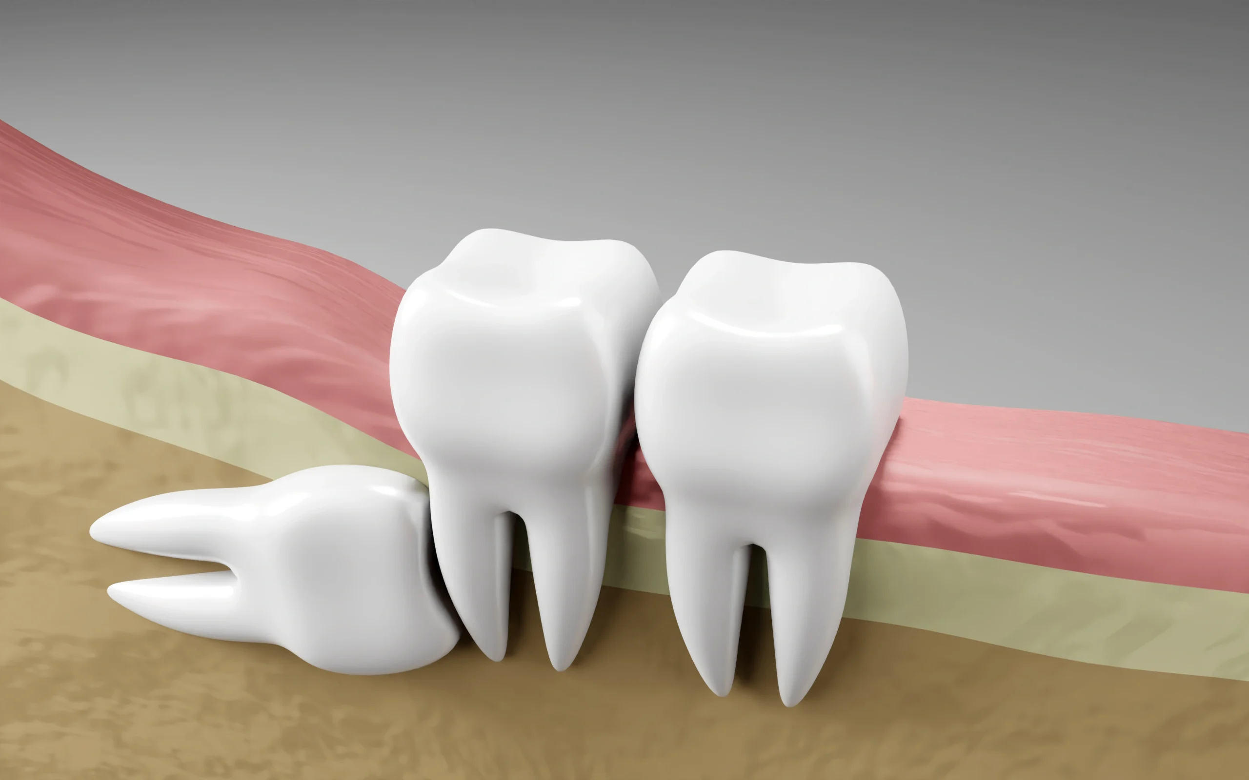 Horizontal wisdom tooth impaction illustration - Dr. Pawar's Advanced Dentistry Thane West