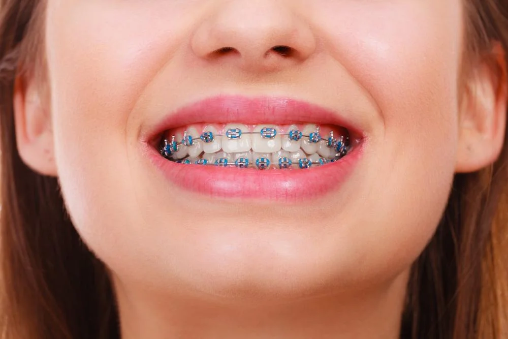 Metallic Braces Treatment - Dr. Pawar's Advanced Dentistry Clinic