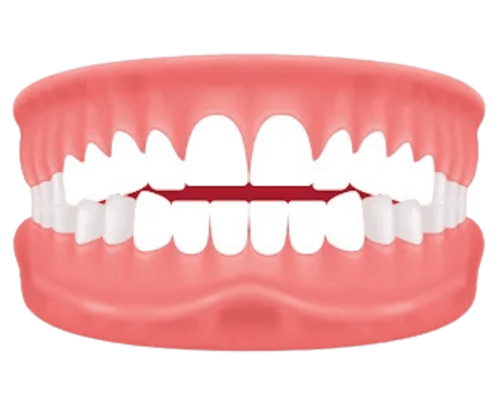 Illustration of an openbite where upper and lower teeth do not touch when biting, an orthodontic condition treatable with custom invisible aligners at Dr. Pawar's Advanced Dentistry in Thane West.