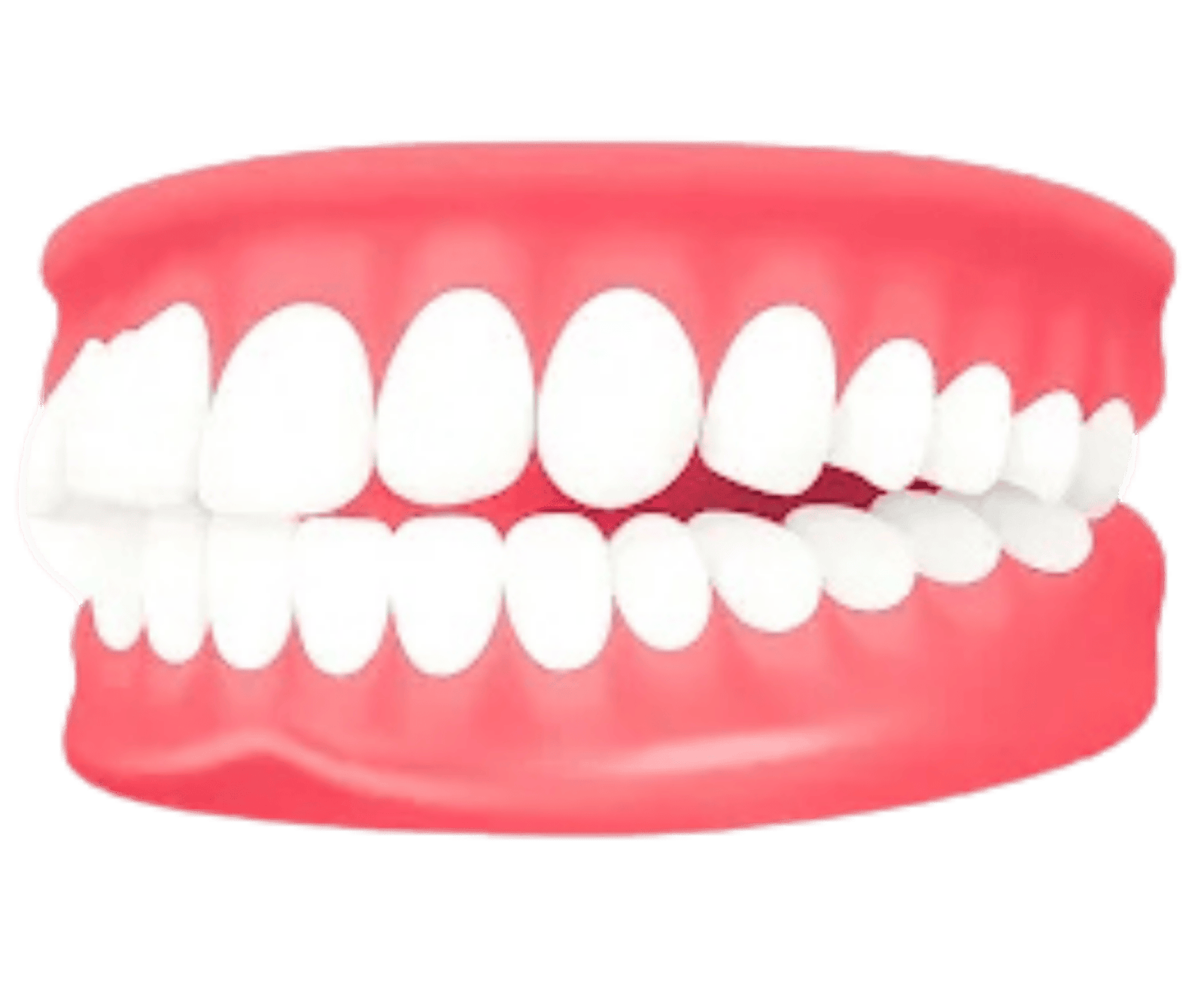Illustration showing an overjet with forward-placed upper teeth, an orthodontic condition treatable with custom invisible aligners at Dr. Pawar's Advanced Dentistry in Thane West.