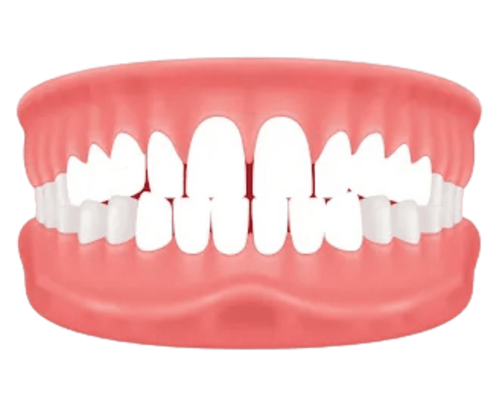 Illustration showing spacing and gaps between teeth, an orthodontic condition treatable with custom invisible aligners at Dr. Pawar's Advanced Dentistry in Thane Wes
