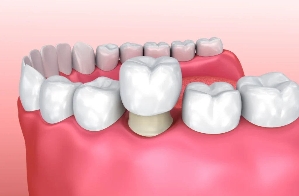 Ceramic tooth crown treatment by Dr. Pawar's Advanced Dentistry in Pokhran Road, Thane