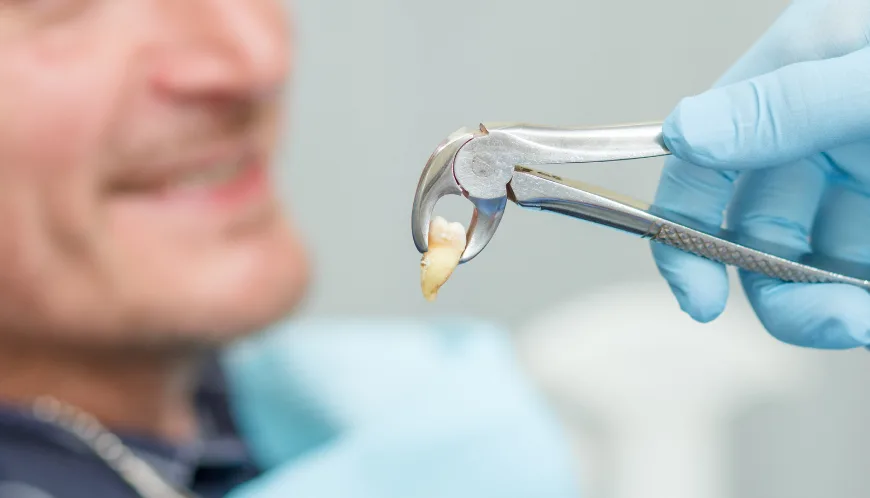 wisdom tooth extraction