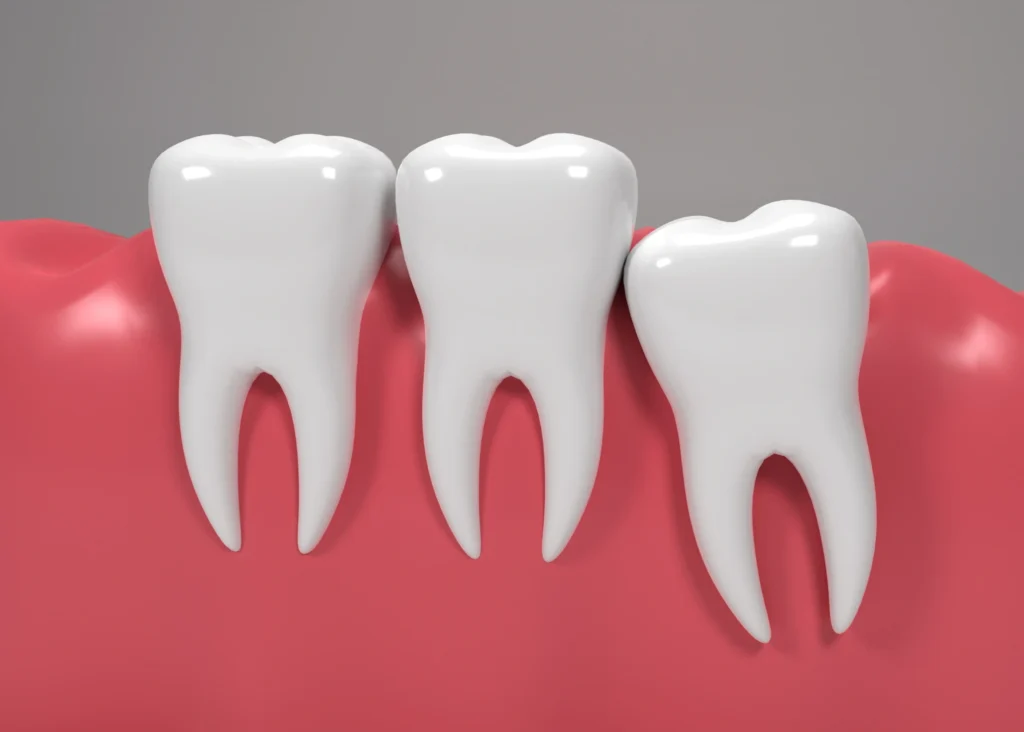 Painless Wisdom Tooth Extraction procedure—Dr. Pawar's Advanced Dentistry Thane West