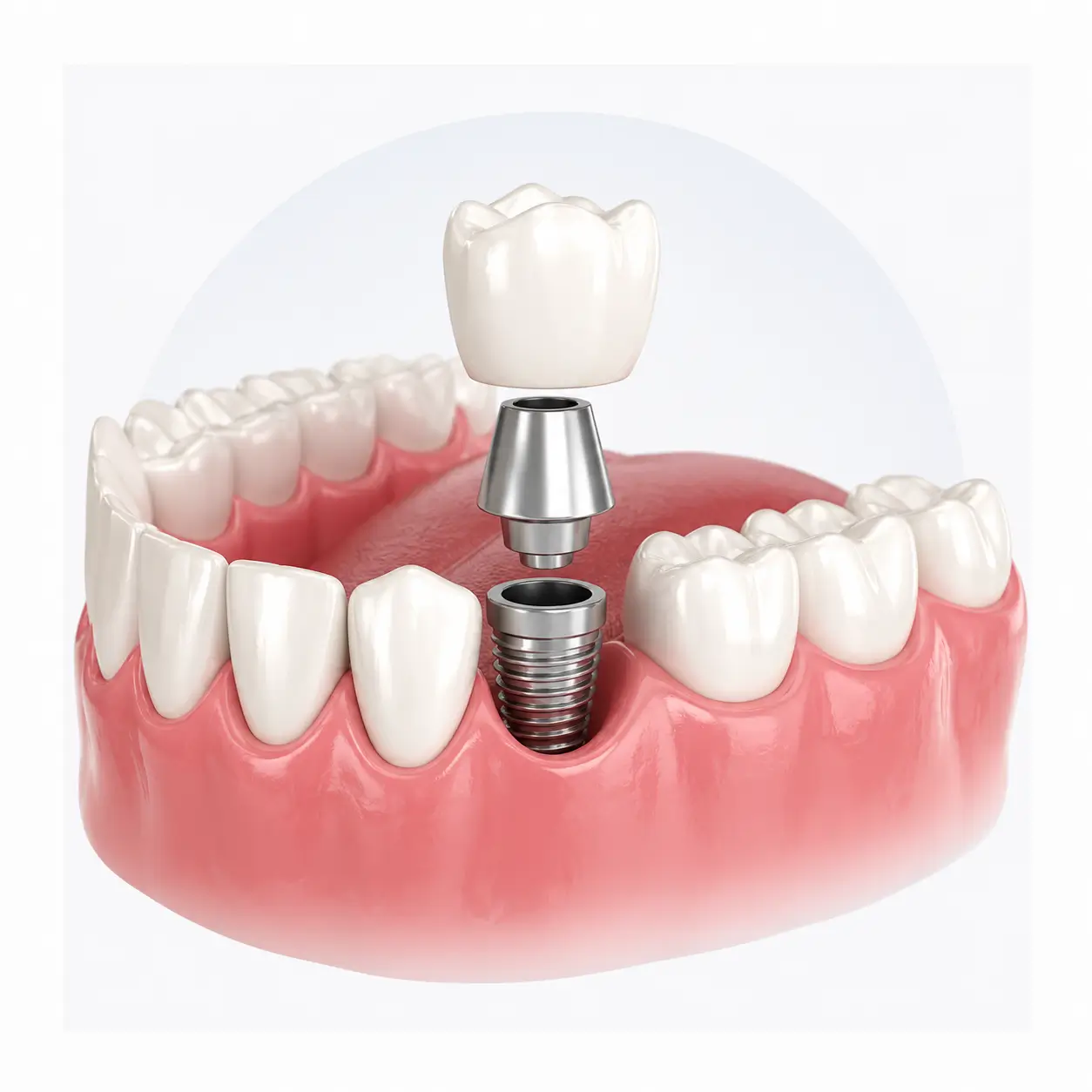 Dental implant procedure and missing teeth replacement at Dr. Pawar's Advanced Dentistry in Thane West