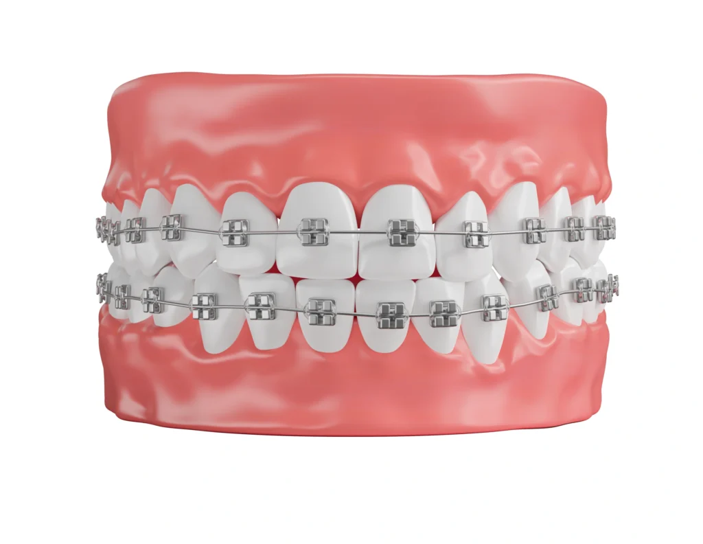 Why Choose Braces - Dr. Pawar's Advanced Dentistry Clinic