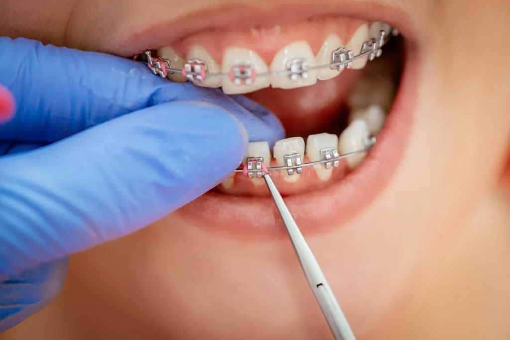 Metal Braces Treatment - Dr. Pawar's Advanced Dentistry Clinic