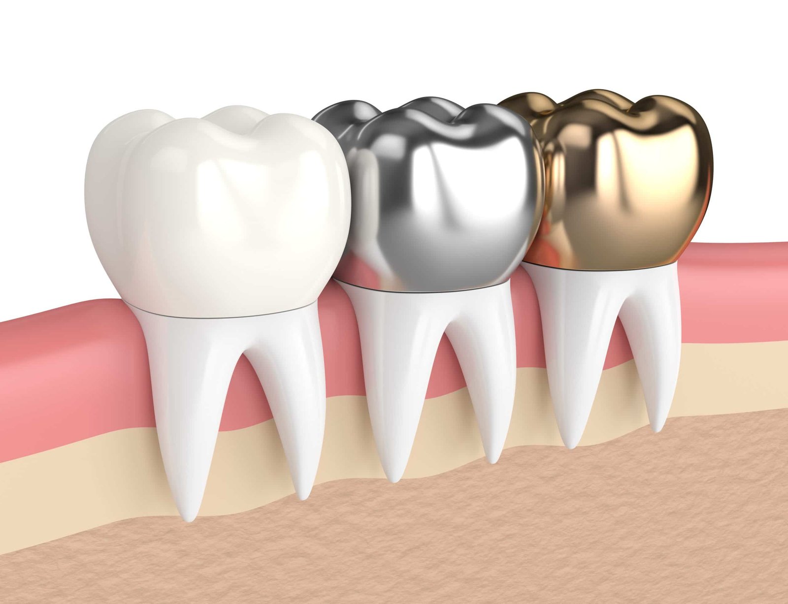 types of dental crowns scaled