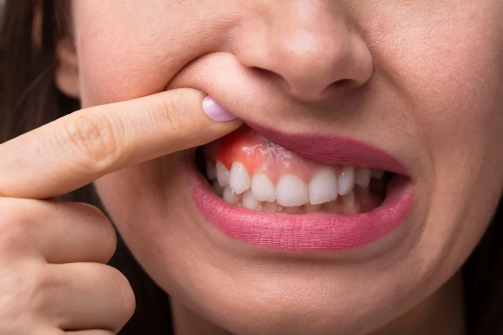 What is Gum Surgery - Dr. Pawar's Advanced Dentistry Clinic
