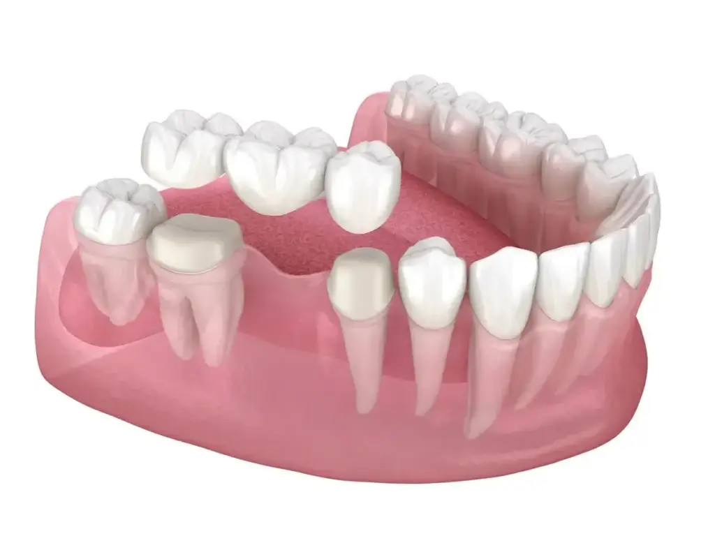 Crowns and Bridges Treatment in Thane West | Dr. Pawar's Advanced Dentistry