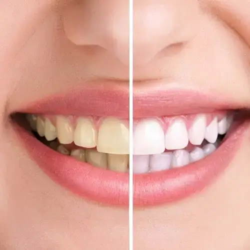 Teeth whitening shade guide comparison at Dr. Pawar's Advanced Dentistry in Thane West