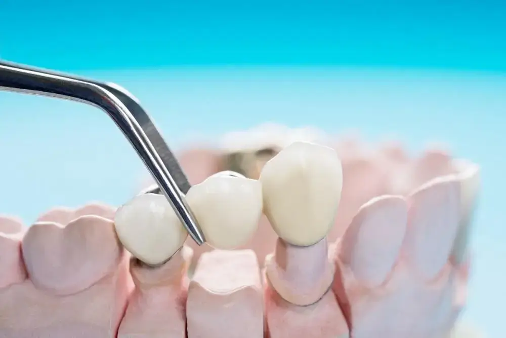 Crowns and Bridges Treatment in Thane West | Dr. Pawar's Advanced Dentistry