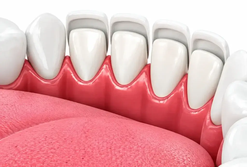 Dental veneers treatment at Dr Pawar Dental Clinic