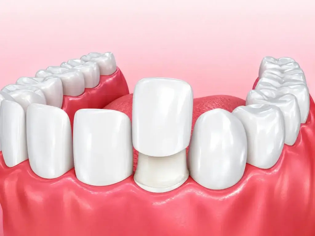 Dental veneers treatment at Dr Pawar Dental Clinic