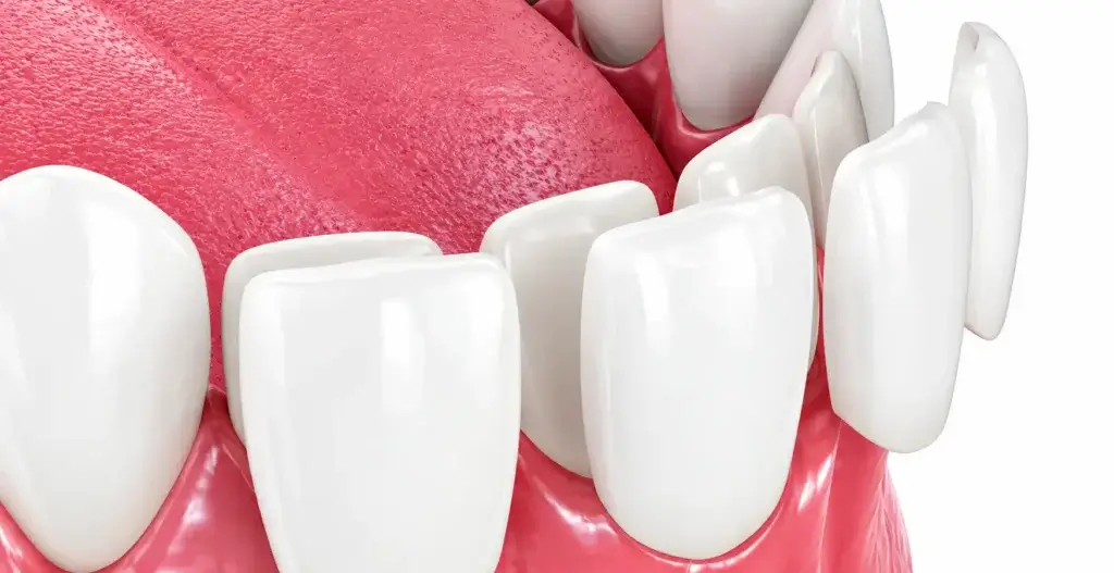 Dental veneers for a brighter and more confident smile at Dr Pawar Dental Clinic.