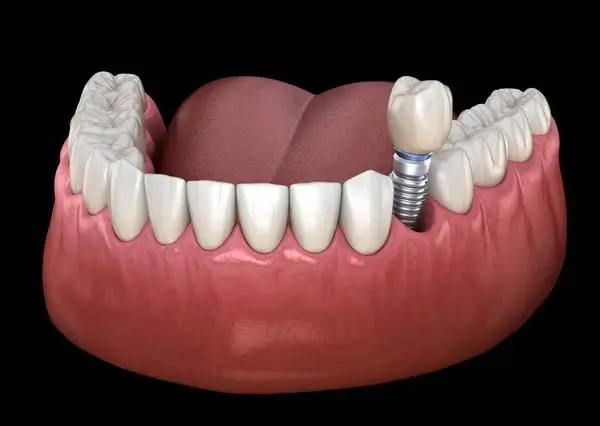Dentist in Thane West Dental Implants Treatment in Thane West | Dr. Pawar's Advanced Dentistry