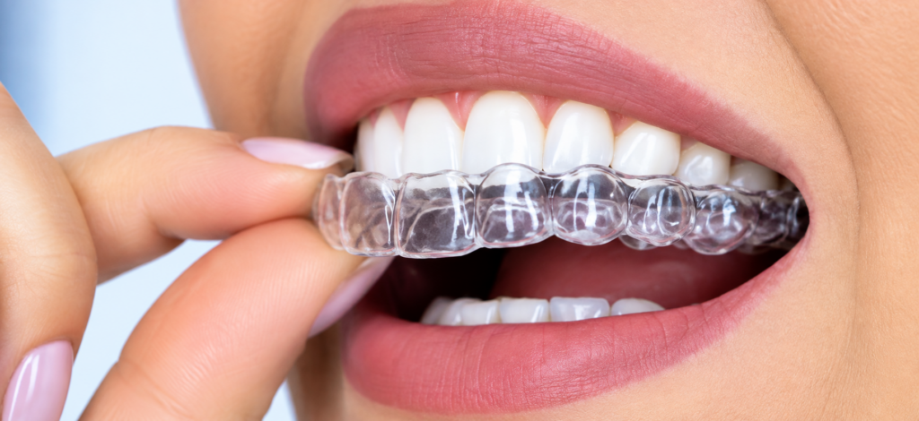Close-up view of clear invisible aligners fitted over teeth during orthodontic treatment at Dr. Pawar's Advanced Dentistry in Thane West.