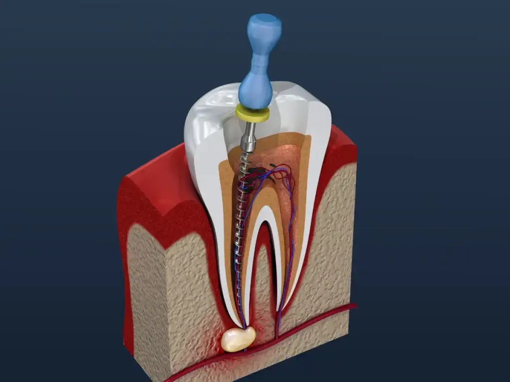 Root Canal Treatment in Thane West - Dr. Pawar's Advanced Dentistry