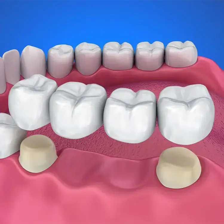 Crowns and Bridges Treatment in Thane West | Dr. Pawar's Advanced Dentistry