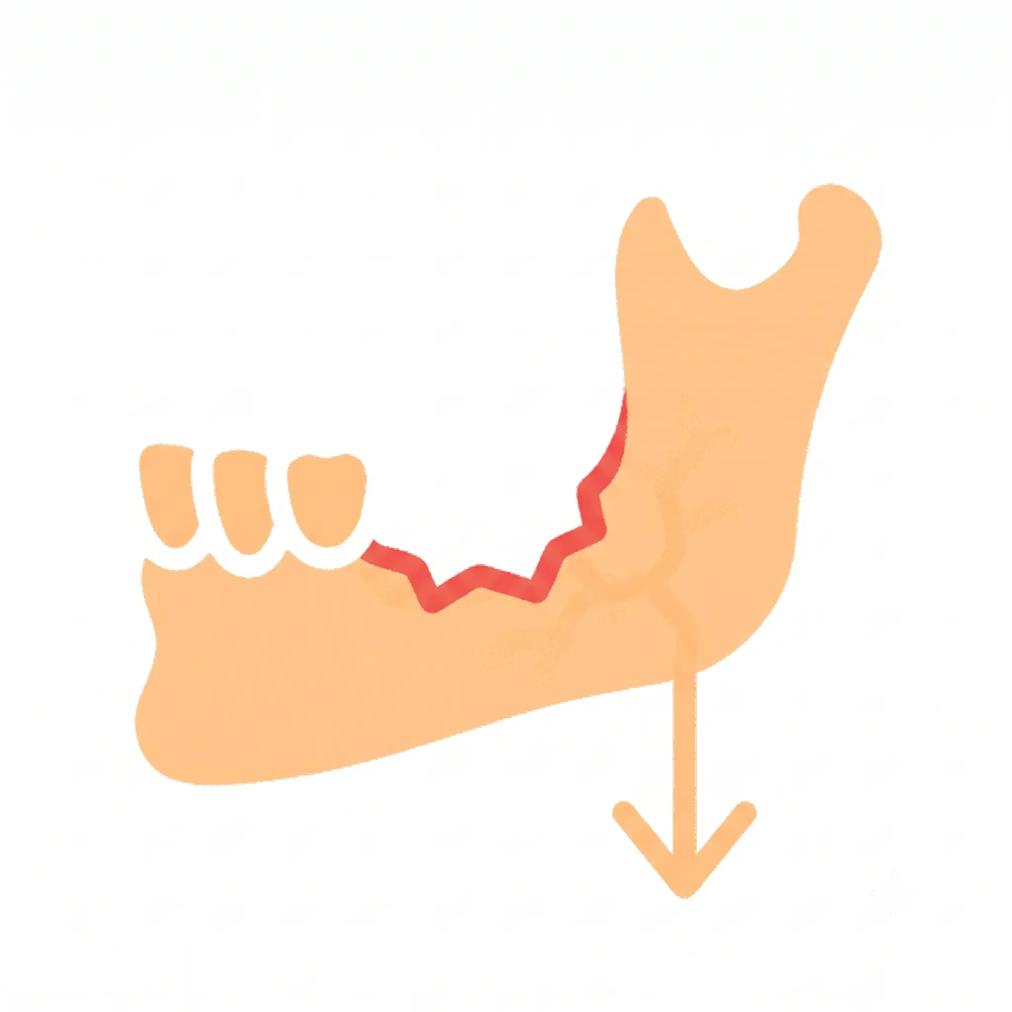 Illustration showing jawbone loss after tooth loss - Dr. Pawar's Advanced Dentistry Thane West