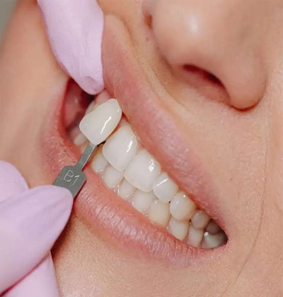 Dental veneers treatment at Dr Pawar Dental Clinic