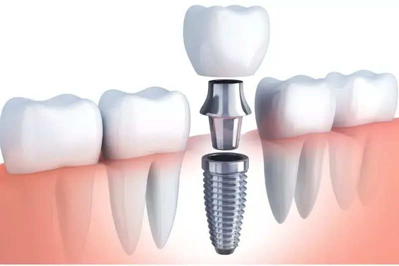 Dentist in Thane West Dental implant restoration model showing a artificial tooth replacement in the jawbone.
