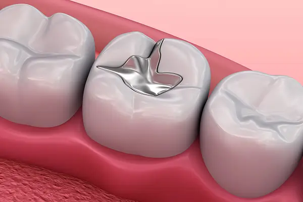 Dentist in Thane West Tooth-Coloured Filling Treatment in Thane West