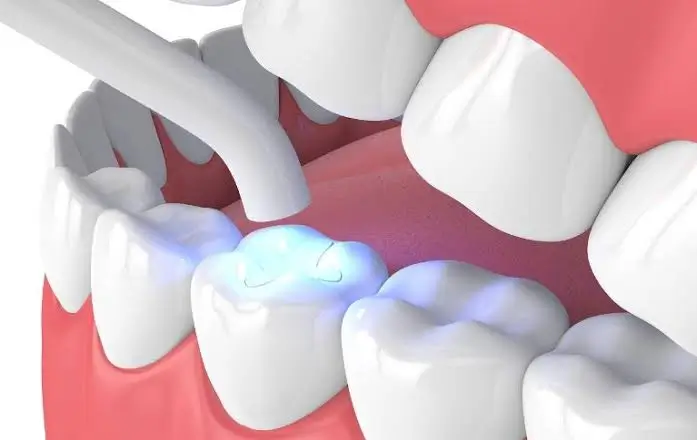 Dentist in Thane West Tooth-Coloured Filling Treatment in Thane West