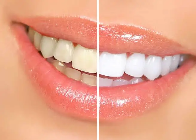 Professional teeth whitening procedure with light activation at Dr. Pawar's Advanced Dentistry in Thane West