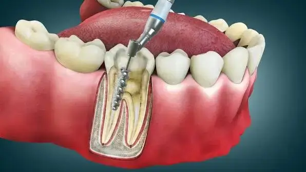 Root Canal Treatment in Thane West | Dr. Pawar's Advanced Dentistry