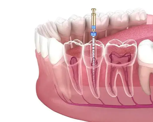 Dentist in Thane West Re-root canal treatment procedure performed by an endodontist in Thane West