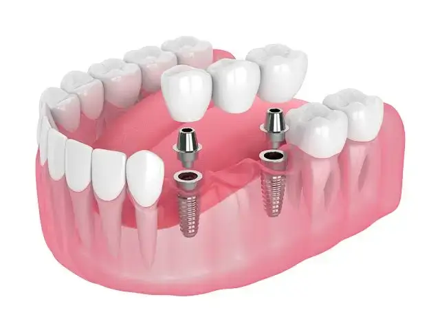 Crowns and Bridges Treatment in Thane West | Dr. Pawar's Advanced Dentistry