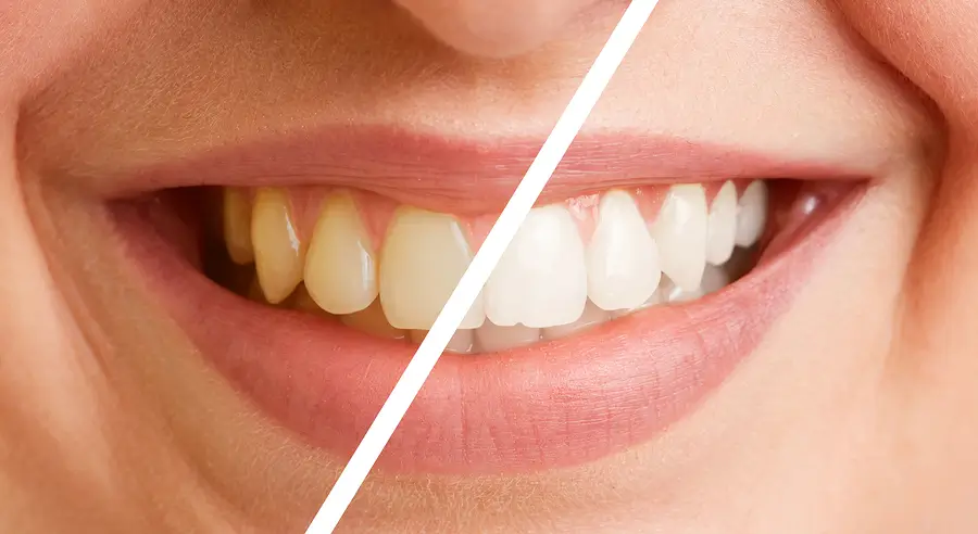 Dentist performing teeth cleaning and polishing procedure on a patient in Thane West.