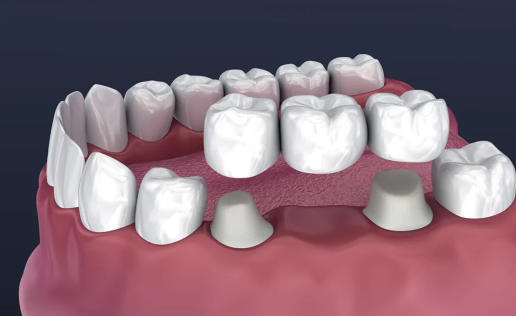 Dental Crowns vs. Bridges Comparison | Dr. Pawar's Advanced Dentistry