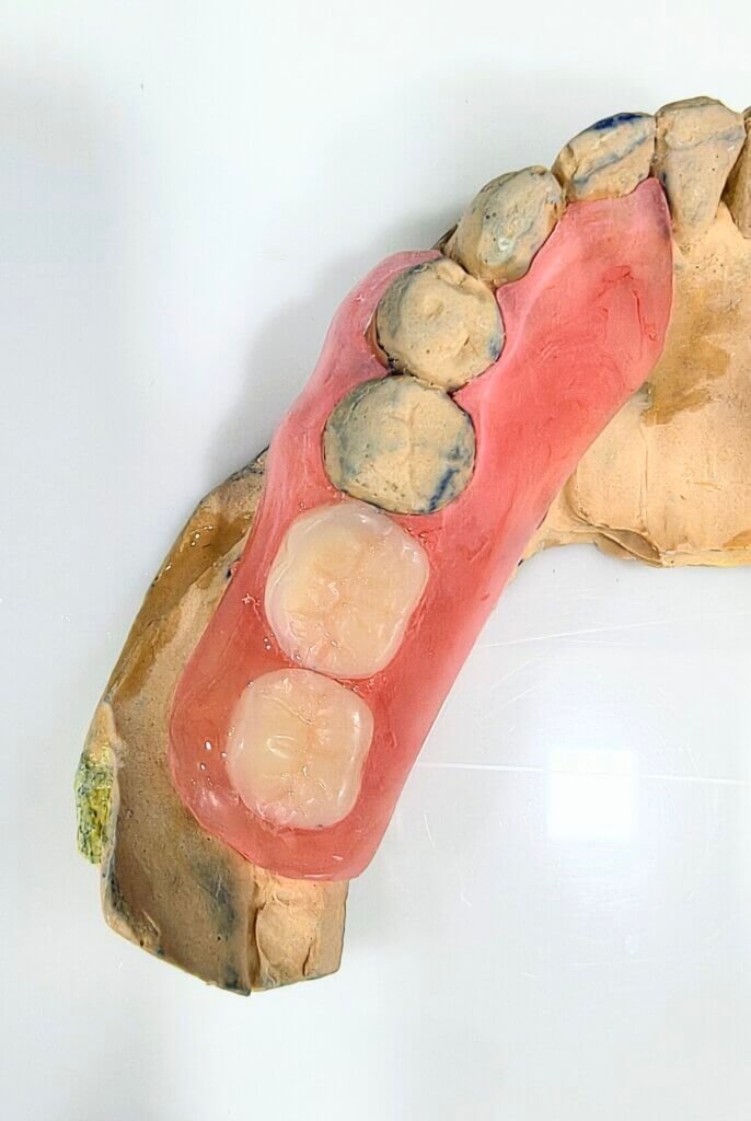 Comfortable and natural-looking flexible partial dentures designed for seamless fit and aesthetics at Dr. Pawar's Advanced Dentistry in Thane West.
